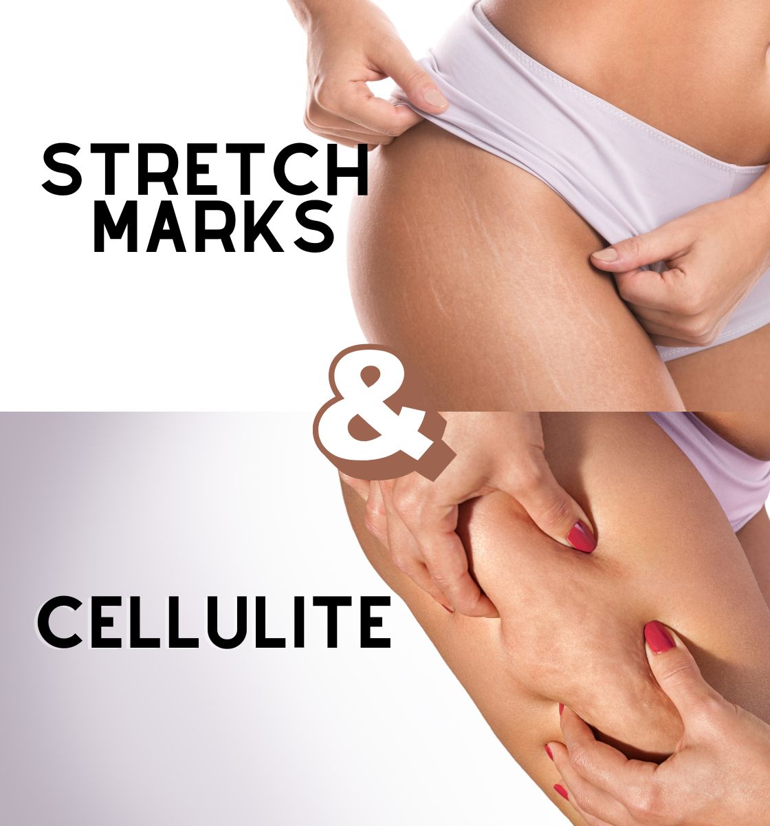 Stretch Mark & Cellulite Skindae