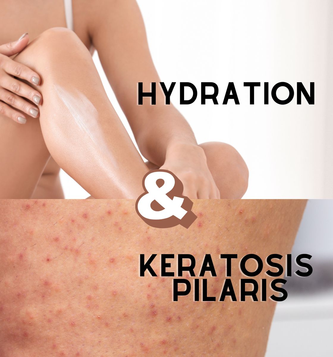 Hydration & Keratosis pilaris
